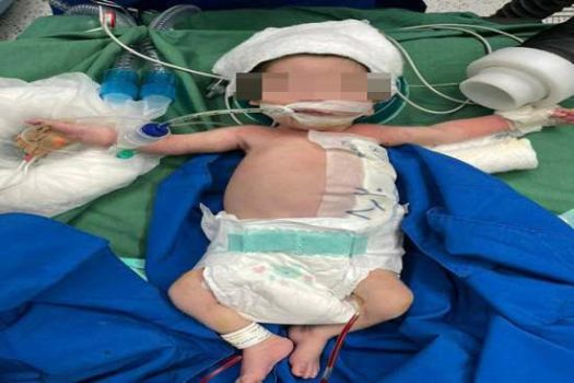 انجام موفقیت‌آمیز عمل جراحی کیست مادرزادی جدار شکم بر روی نوزاد ۱۱ روزه در مرکز آموزشی و درمانی ۱۷ شهریور
