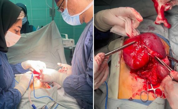 خارج کردن تومور شکمی از بدن کودک ۱۰ساله در مرکز آموزشی و درمانی ۱۷ شهریور رشت خارج کردن تومور شکمی از بدن کودک ۱۰ساله در مرکز آموزشی و درمانی ۱۷ شهریور رشت